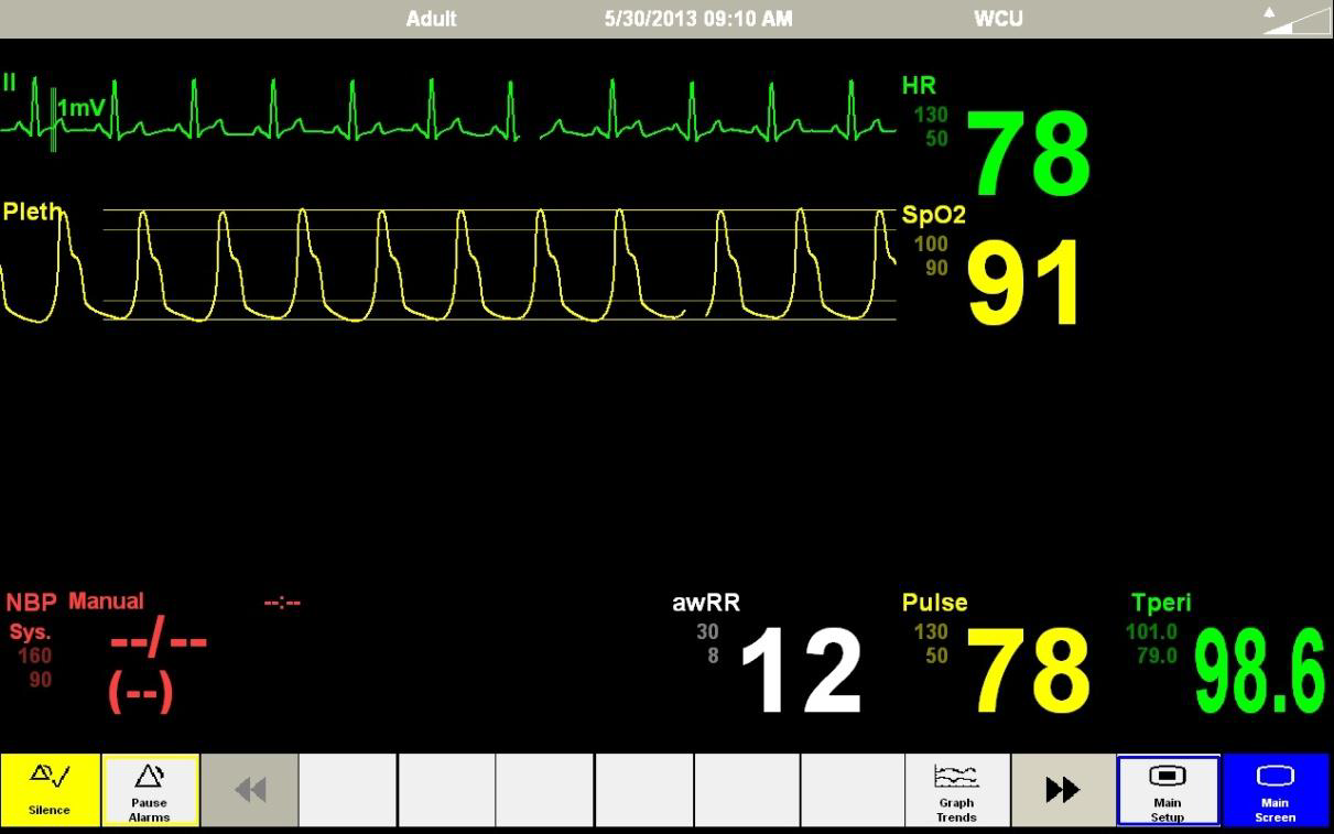 Why is my SimMan 3G's patient monitor losing the Heart Rate and SpO2 ...